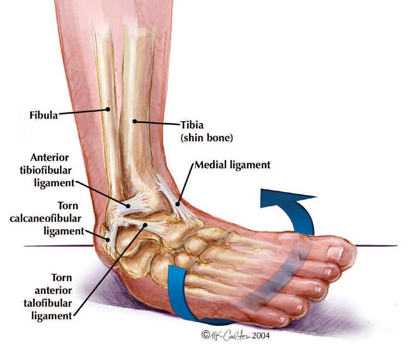 Dealing with Ankle Sprains